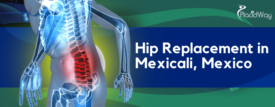 Hip Replacement in Mexicali, Mexico - Cost & Clinics